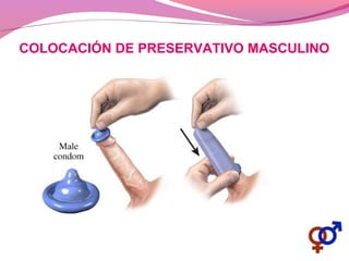 COLOCACIÓN DE PRESERVATIVO MASCULINO
 