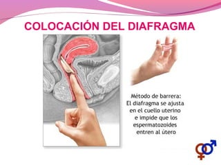 COLOCACIÓN DEL DIAFRAGMA
 