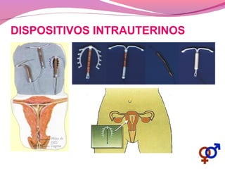 DISPOSITIVOS INTRAUTERINOS
 