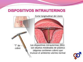DISPOSITIVOS INTRAUTERINOS
 