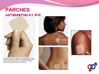 PARCHES
HORMONALES
 