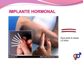 IMPLANTE HORMONAL
Dura entre 6 meses
y 6 años
 