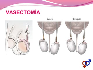 VASECTOMÍA
 
