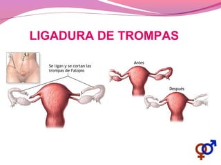 LIGADURA DE TROMPAS
 