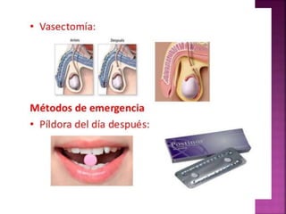 Metodos anticonceptivos  