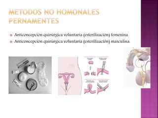  Anticoncepción quirúrgica voluntaria (esterilización) femenina.
 Anticoncepción quirúrgica voluntaria (esterilización) masculina.
 