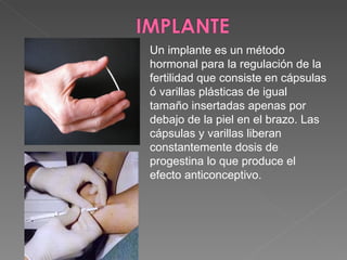 Un implante es un método
hormonal para la regulación de la
fertilidad que consiste en cápsulas
ó varillas plásticas de igual
tamaño insertadas apenas por
debajo de la piel en el brazo. Las
cápsulas y varillas liberan
constantemente dosis de
progestina lo que produce el
efecto anticonceptivo.
 