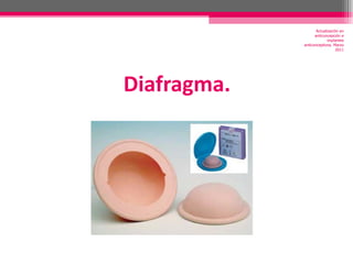Diafragma. Actualización en anticoncepción e implantes anticonceptivos. Marzo 2011 