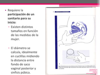 Requiere la  participación de un sanitario para su inicio: Existen distintos tamaños en función de las medidas de la mujer. El diámetro se calcula, idealmente en cuclillas midiendo la distancia entre fondo de saco vaginal posterior y sinfisis púbica. Actualización en anticoncepción e implantes anticonceptivos. Marzo 2011 