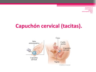 Capuchón cervical (tacitas). Actualización en anticoncepción e implantes anticonceptivos. Marzo 2011 