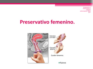 Preservativo femenino. Actualización en anticoncepción e implantes anticonceptivos. Marzo 2011 