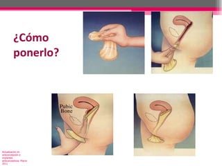 ¿Cómo ponerlo? Actualización en anticoncepción e implantes anticonceptivos. Marzo 2011 