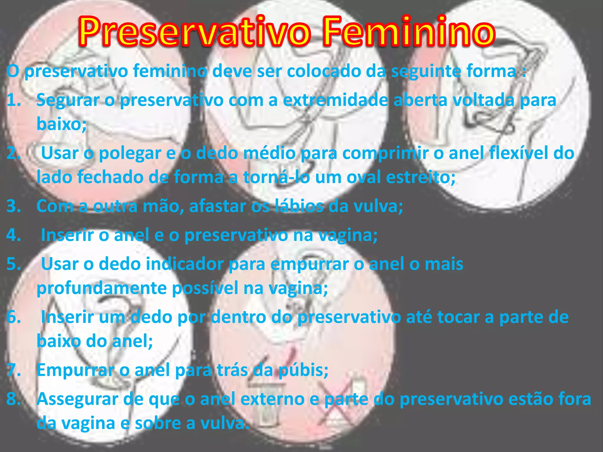 Preservativo FemininoO preservativo feminino deve ser colocado da seguinte forma :Segurar o preservativo com a extremidade aberta voltada para baixo;Usar o polegar e o dedo médio para comprimir o anel flexível do lado fechado de forma a torná-lo um oval estreito;Com a outra mão, afastar os lábios da vulva;Inserir o anel e o preservativo na vagina;Usar o dedo indicador para empurrar o anel o mais profundamente possível na vagina;Inserir um dedo por dentro do preservativo até tocar a parte de baixo do anel;Empurrar o anel para trás da púbis;Assegurar de que o anel externo e parte do preservativo estão fora da vagina e sobre a vulva.