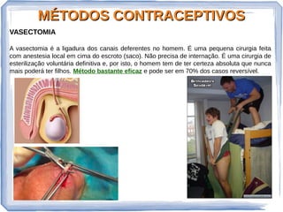MÉTODOS CONTRACEPTIVOSMÉTODOS CONTRACEPTIVOS
VASECTOMIA
A vasectomia é a ligadura dos canais deferentes no homem. É uma pequena cirurgia feita
com anestesia local em cima do escroto (saco). Não precisa de internação. É uma cirurgia de
esterilização voluntária definitiva e, por isto, o homem tem de ter certeza absoluta que nunca
mais poderá ter filhos. Método bastante eficaz e pode ser em 70% dos casos reversível.
 