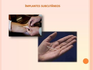 IMPLANTES SUBCUTÂNEOS
 