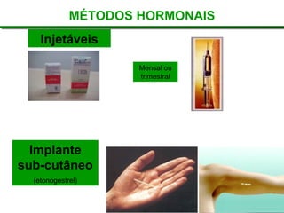 Injetáveis Mensal ou trimestral Implante sub-cutâneo (etonogestrel) MÉTODOS HORMONAIS 