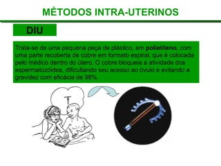 Trata-se de uma pequena peça de plástico, em  polietileno , com uma parte recoberta de cobre em formato espiral, que é colocada pelo médico dentro do útero. O cobre bloqueia a atividade dos espermatozóides, dificultando seu acesso ao óvulo e evitando a gravidez com eficácia de 98%.  MÉTODOS INTRA-UTERINOS DIU 