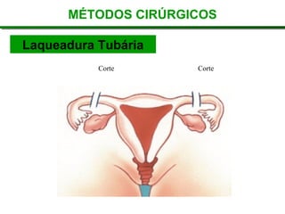 MÉTODOS CIRÚRGICOS Laqueadura Tubária Corte Corte 