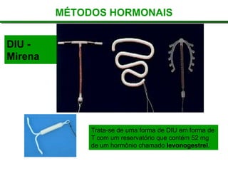 DIU -
Mirena
Trata-se de uma forma de DIU em forma de
T com um reservatório que contém 52 mg
de um hormônio chamado levonogestrel.
MÉTODOS HORMONAIS
 
