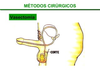 MÉTODOS CIRÚRGICOS
Vasectomia
 