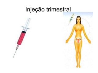 Injeção trimestral
 