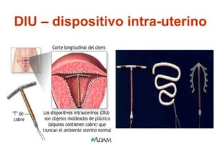 DIU – dispositivo intra-uterino
 