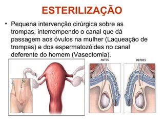 ESTERILIZAÇÃO
• Pequena intervenção cirúrgica sobre as
trompas, interrompendo o canal que dá
passagem aos óvulos na muIher (Laqueação de
trompas) e dos espermatozóides no canal
deferente do homem (Vasectomia).
 