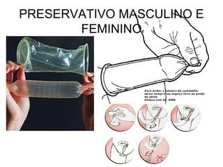 PRESERVATIVO MASCULINO E
FEMININO
 