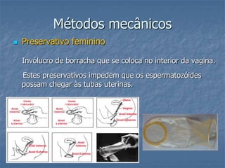 Métodos mecânicos
 Preservativo feminino
Invólucro de borracha que se coloca no interior da vagina.
Estes preservativos impedem que os espermatozóides
possam chegar às tubas uterinas.
 