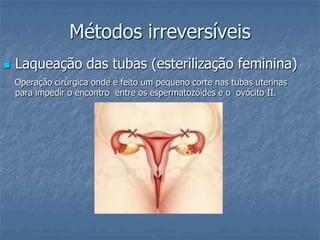 Métodos irreversíveis
 Laqueação das tubas (esterilização feminina)
Operação cirúrgica onde é feito um pequeno corte nas tubas uterinas
para impedir o encontro entre os espermatozóides e o ovócito II.
 