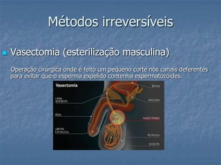 Métodos irreversíveis
 Vasectomia (esterilização masculina)
Operação cirúrgica onde é feito um pequeno corte nos canais deferentes
para evitar que o esperma expelido contenha espermatozóides.
 