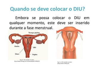 Quando se deve colocar o DIU?
   Embora se possa colocar o DIU em
qualquer momento, este deve ser inserido
durante a fase menstrual.




            Fig.10 - DIU inserido no útero
  (http://www.fotolog.com.br/sexualidade/74789297)
                                                     Fig. 11 - DIU inserido no útero
                                                     (http://www.unifesp.br)
 