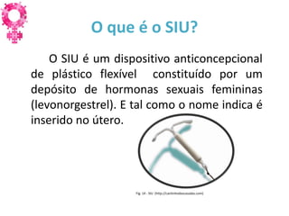 O que é o SIU?
    O SIU é um dispositivo anticoncepcional
de plástico flexível constituído por um
depósito de hormonas sexuais femininas
(levonorgestrel). E tal como o nome indica é
inserido no útero.




                   Fig. 14 - SIU (http://cantinhodascasadas.com)
 