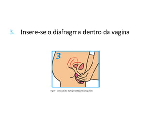 3. Insere-se o diafragma dentro da vagina




              Fig.19 - Colocação do diafragma (http://bluelogs.net)
 