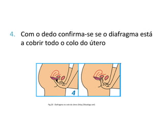 4. Com o dedo confirma-se se o diafragma está
   a cobrir todo o colo do útero




            Fig.20 - Diafragma no colo do útero (http://bluelogs.net)
 