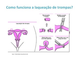 Como funciona a laqueação de trompas?




   Fig.21 - (http://www.manualmerck.net)
 