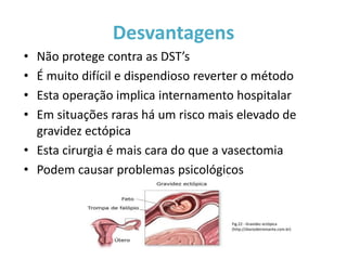 Desvantagens
• Não protege contra as DST’s
• É muito difícil e dispendioso reverter o método
• Esta operação implica internamento hospitalar
• Em situações raras há um risco mais elevado de
  gravidez ectópica
• Esta cirurgia é mais cara do que a vasectomia
• Podem causar problemas psicológicos


                                     Fig.22 - Gravidez ectópica
                                     (http://diariodetreinante.com.br)
 