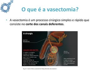 O que é a vasectomia?
• A vasectomia é um processo cirúrgico simples e rápido que
  consiste no corte dos canais deferentes.




            Fig. 23 - Como é feita a vasectomia? (http://drandre.site.med.br/ )
 