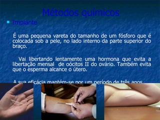 Métodos químicos Implante   É uma pequena vareta do tamanho de um fósforo que é colocada sob a pele, no lado interno da parte superior do braço. Vai libertando lentamente uma hormona que evita a libertação mensal  de oócitos II do ovário. Também evita que o esperma alcance o útero. A sua eficácia mantém-se por um período de três anos. 