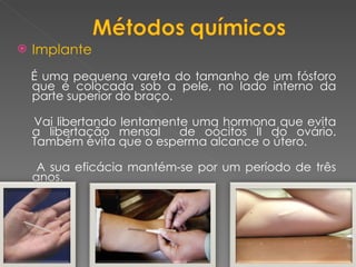 Implante   É uma pequena vareta do tamanho de um fósforo que é colocada sob a pele, no lado interno da parte superior do braço. Vai libertando lentamente uma hormona que evita a libertação mensal  de oócitos II do ovário. Também evita que o esperma alcance o útero. A sua eficácia mantém-se por um período de três anos. 