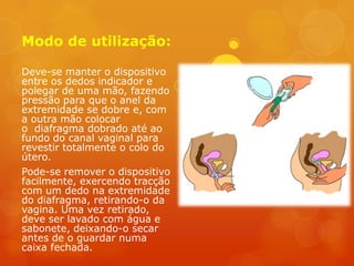 Modo de utilização:

Deve-se manter o dispositivo
entre os dedos indicador e
polegar de uma mão, fazendo
pressão para que o anel da
extremidade se dobre e, com
a outra mão colocar
o diafragma dobrado até ao
fundo do canal vaginal para
revestir totalmente o colo do
útero.
Pode-se remover o dispositivo
facilmente, exercendo tracção
com um dedo na extremidade
do diafragma, retirando-o da
vagina. Uma vez retirado,
deve ser lavado com água e
sabonete, deixando-o secar
antes de o guardar numa
caixa fechada.
 