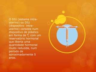 O SIU (sistema intra-
uterino) ou DIU
(dispositivo intra-
uterino) consiste num
dispositivo de plástico
em forma de T, com um
reservatório hormonal
que liberta uma
quantidade hormonal
muito reduzida, num
período de
aproximadamente 5
anos.
 