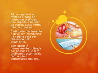 Pílula vaginal é um
método á base de
hormonas artificias ,
que impede a mulher
de ovular, desta forma
não há gravidez.
É utilizada diariamente
e deve ser introduzida
na vagina para ser
absorvida pelo
organismo.
Esta opção é
normalmente utilizada
por pessoas que têm
problemas estomacais
com a pílula
anticoncepcional oral.
 