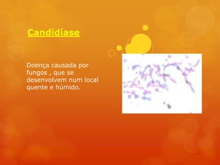 Candidíase


Doença causada por
fungos , que se
desenvolvem num local
quente e húmido.
 
