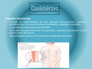Injeções hormonais 
• Consiste na administração de uma injecção intra-muscular, contendo 
substância que, tal como as pílulas combinadas, impedem a ovulação. 
• A sua eficácia é elevada (cerca de 99%), 
• Pare além de prevenirem de uma gravidez, aumenta a protecção contra 
diversos tipos de cancro. 
• Não protegem contra as IST, e provoca a alteração hormonal 
 