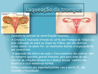 • Consiste no método de esterilização feminina. 
• A cirurgia é realizada através do corte das trompas de falópio ou 
pela colocação de anéis ou clipes de titânio, que vão obstruir 
estes canais. Se assim for, os resultados destas cirurgia poderão 
ser reversíveis. 
• A operação não altera em nada o funcionamento dos ovários, nem 
do restante aparelho genital feminino, pois para além de não 
afectar as relações sexuais ou o desejo sexual, também não 
modifica o ciclo menstrual normal. 
• Evita o contacto dos espermatozóides com o oócito II, não 
havendo a fecundação 
 