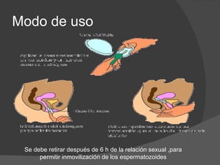 Modo de uso




 Se debe retirar después de 6 h de la relación sexual ,para
      permitir inmovilización de los espermatozoides
 
