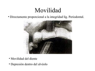 Movilidad
• Directamente proporcional a la integridad lig. Periodontal.
• Movilidad del diente
• Depresión dentro del alvéolo
 