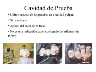 Cavidad de Prueba
• Último recurso en las pruebas de vitalidad pulpar.
• Sin anestesia.
• Acción del calor de la fresa.
• No es una indicación exacta del grado de inflamación
pulpar.
 