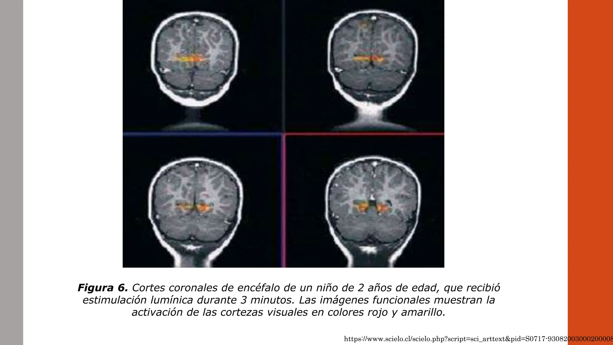 Figura 6. Cortes coronales de encéfalo de un niño de 2 años de edad, que recibió
estimulación lumínica durante 3 minutos. Las imágenes funcionales muestran la
activación de las cortezas visuales en colores rojo y amarillo.
https://www.scielo.cl/scielo.php?script=sci_arttext&pid=S0717-93082003000200008
 